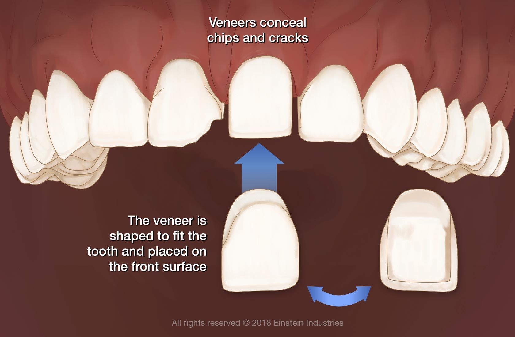 Diagram of veneers