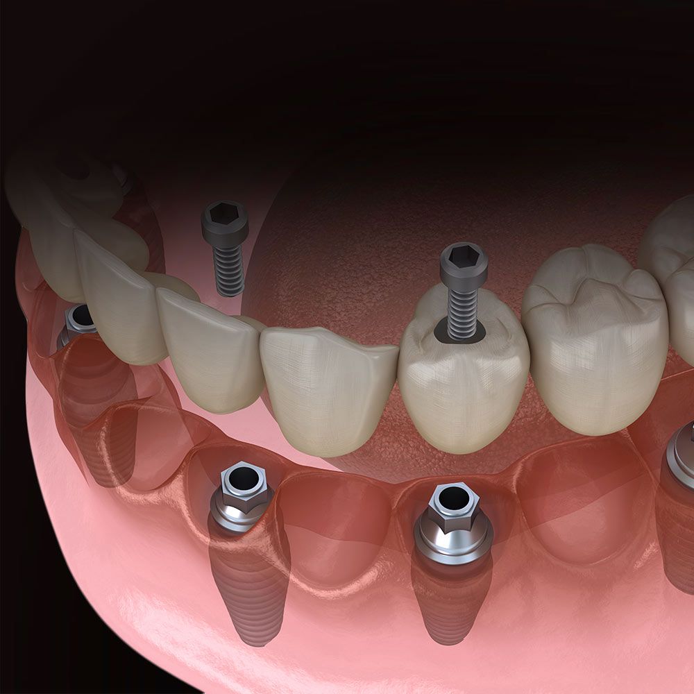 Implant denture