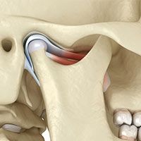 TMJ Disorders