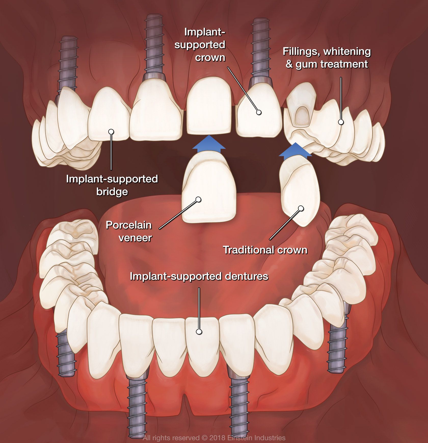 Full Mouth Reconstruction Procedures