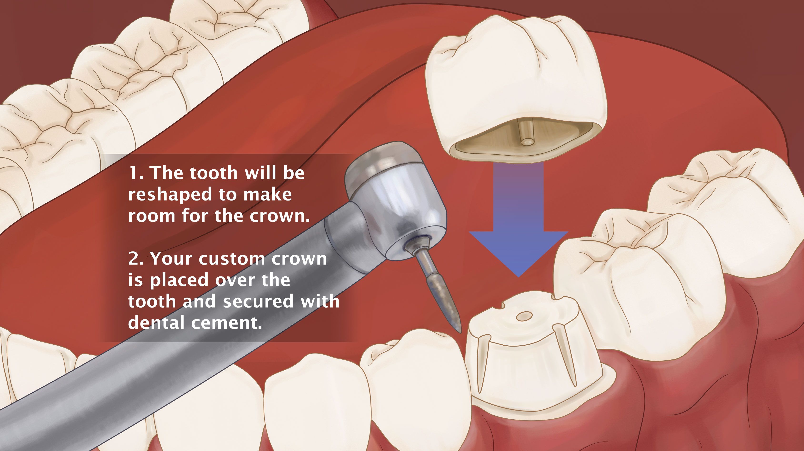 Dental crown illustration
